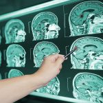 Penyebab Cedera Otak yang Dialami Oleh Penduduk di Texas
