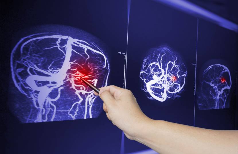 Cedera otak traumatik, umumnya terjadi di Amerika Serikat post thumbnail image